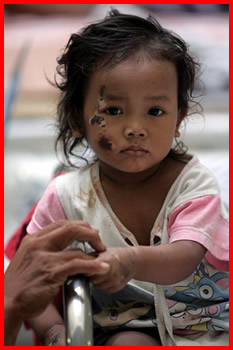 Injured Child